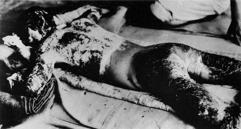An atomic bomb victim with whole body burned.