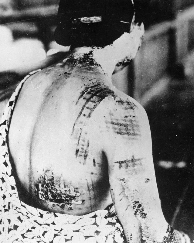 The patient's skin is burned in a pattern corresponding to the dark portions of a *kimono*.