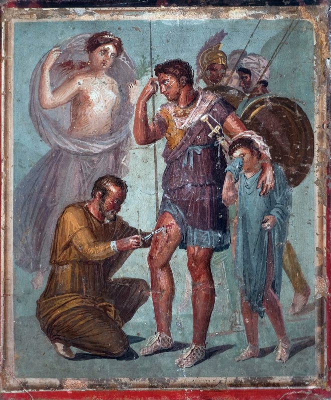 Iapyx removing an arrowhead from Aeneas' thigh, using a tweezer-like instrument made of metal, Pompeian fresco, 1st century CE.